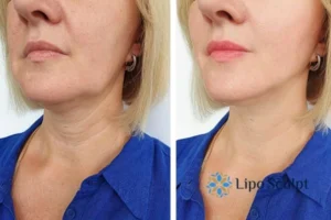Double chin before and after Hi-Fu treatment 4 Book your double chin treatment Hertfordshire today! We are here to help!