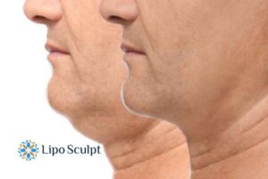 Double chin before and after Hi-Fu treatment 2 Double chin treatment Hertfordshire from Lipo Sculpt - feel more confident today!