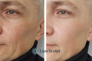 How to Fight Aging Symptoms 3 Fight Aging Symptoms Hertfordshire With HIFU and Morpheus8 Today!