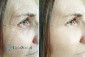 How to Fight Aging Symptoms 2 Do you want to Fight Aging Symptoms Hertfordshire? Contact Lipo Sculpt today!