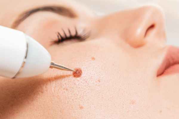 CryoPen: 5 Skin Concerns It May Be Used to Treat 3 What actually happens during a CryoPen treatment Hertfordshire?