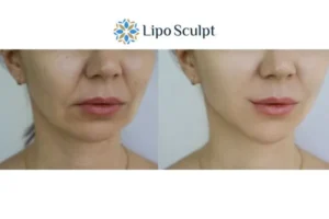 Explaining Total Skin Tightening Treatment And What It Can Do For You 2 Do you want to boost your self confidence? Give Morpheus8 Hertfordshire a try today!