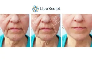 Explaining Total Skin Tightening Treatment And What It Can Do For You 3 Boost your confidence with Morpheus8 Hertfordshire call our team today!
