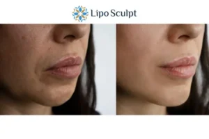 Explaining Total Skin Tightening Treatment And What It Can Do For You 4 Morpheus8 Hertfordshire the best results - call our team today!