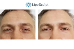 Explaining Total Skin Tightening Treatment And What It Can Do For You 6 Morpheus8 Hertfordshire book in today to find out more!