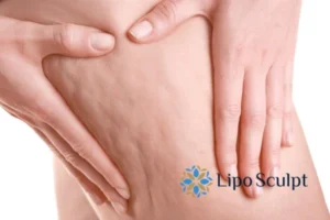 CoolSculpting for Legs: The Innovative Approach to Redefining Your Legs 5 Start your journey today book your coolsculpting treatment Hertfordshire online today!